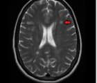 MRI可以帮助预测多发性硬化症的进展