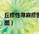 丘疹性荨麻疹图片和症状图片（丘疹性荨麻疹图）