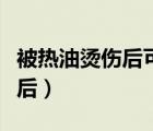 被热油烫伤后可以涂新鲜芦荟吗（被热油烫伤后）