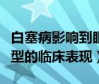 白塞病影响到眼睛怎么治疗（白塞病眼部最典型的临床表现）