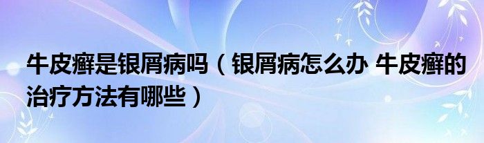 牛皮癣是银屑病吗（银屑病怎么办 牛皮癣的治疗方法有哪些）